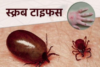 कोभिड–१९ जस्तै लक्षण भएको ‘स्क्रब टाइफस’ रोग, यस्ता छन् बच्ने उपाय